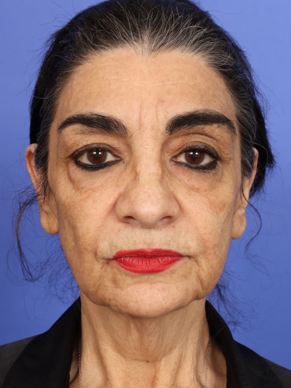 Face and Neck Lift Before & After Image