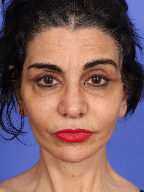 Face and Neck Lift Before & After Image