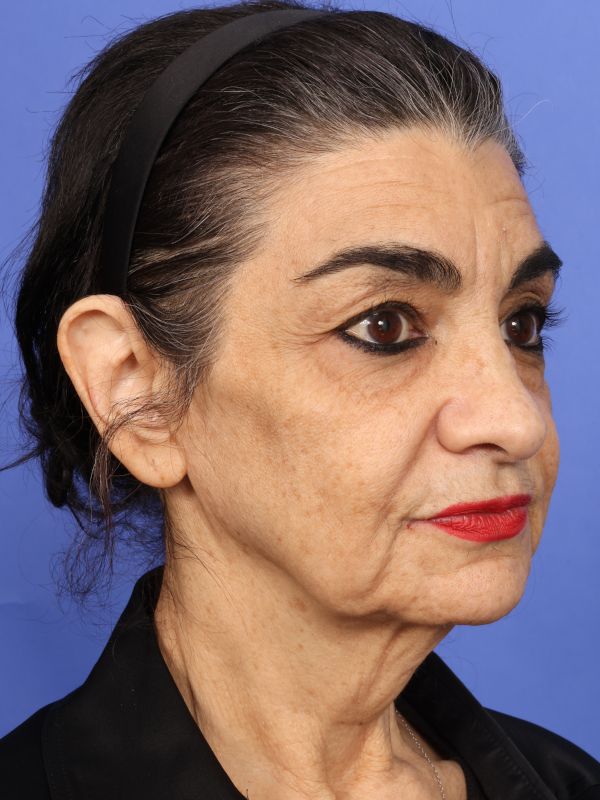 Face and Neck Lift Before & After Image