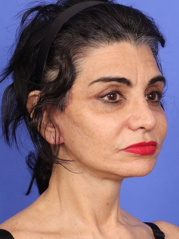 Face and Neck Lift Before & After Image