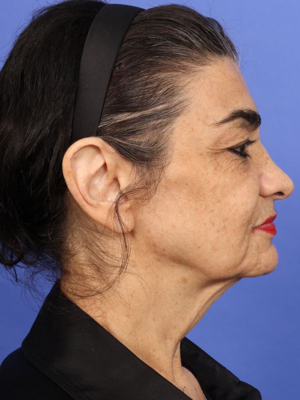 Face and Neck Lift Before & After Image