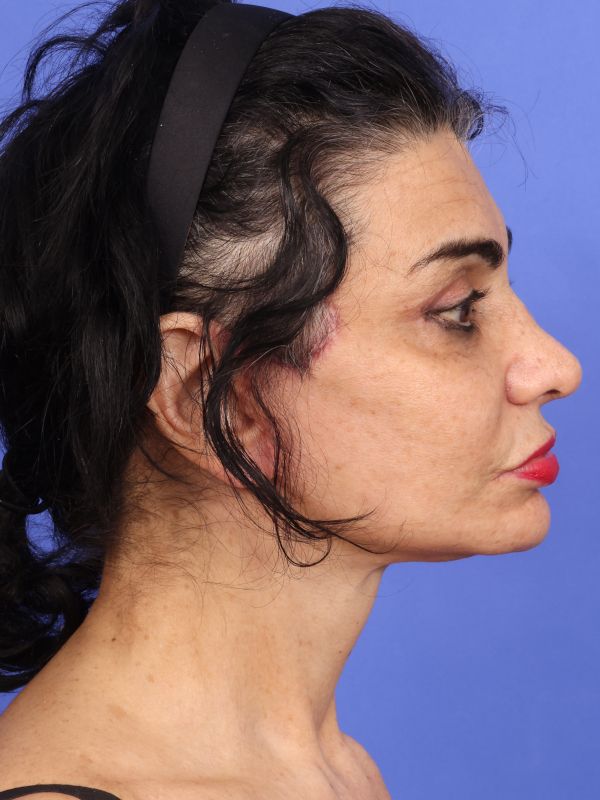 Face and Neck Lift Before & After Image