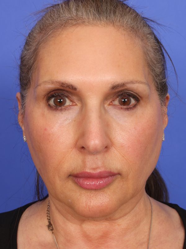 Face and Neck Lift Before & After Image