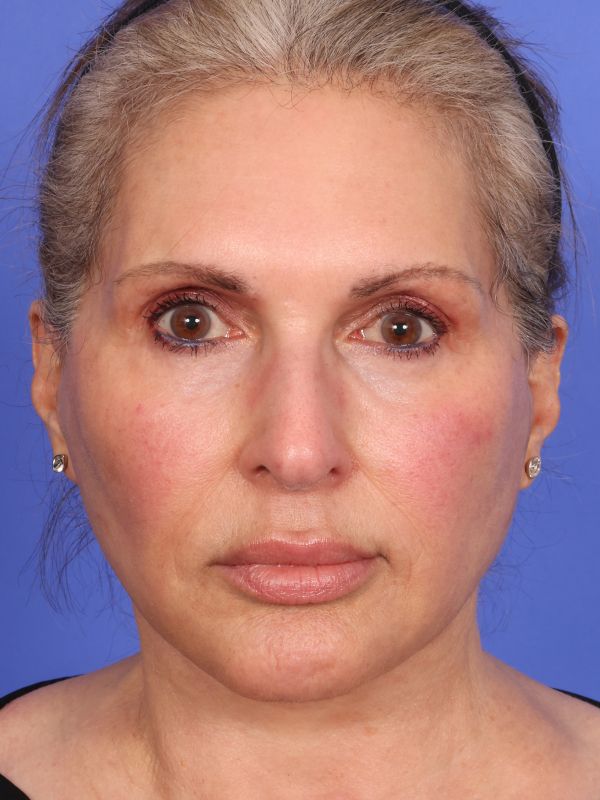 Face and Neck Lift Before & After Image