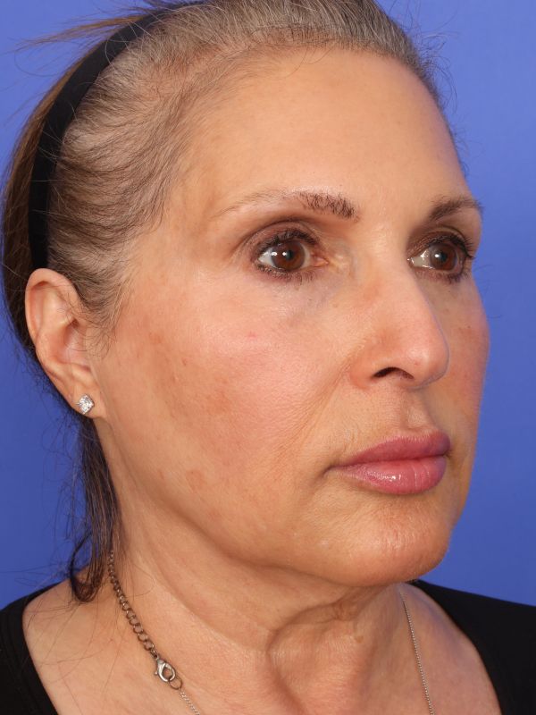 Face and Neck Lift Before & After Image
