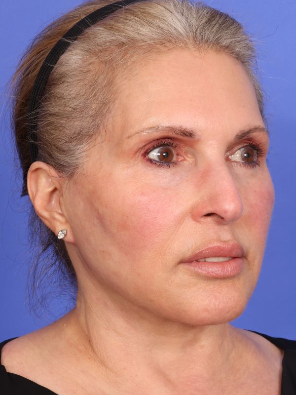 Face and Neck Lift Before & After Image
