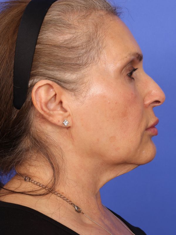 Face and Neck Lift Before & After Image