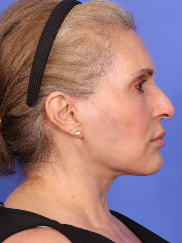 Face and Neck Lift Before & After Image