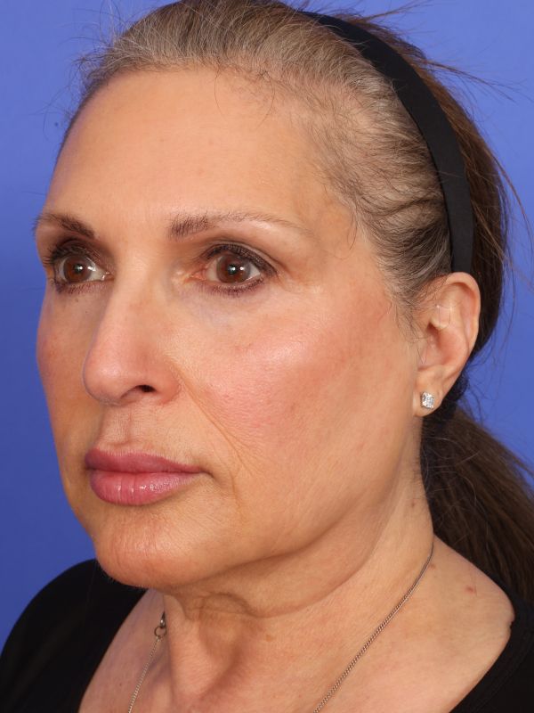 Face and Neck Lift Before & After Image