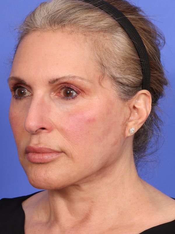 Face and Neck Lift Before & After Image