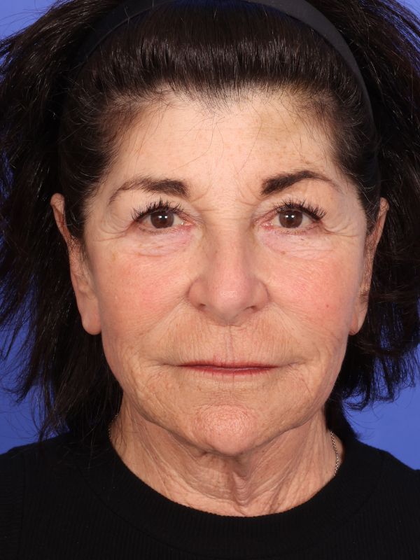 Face and Neck Lift Before & After Image