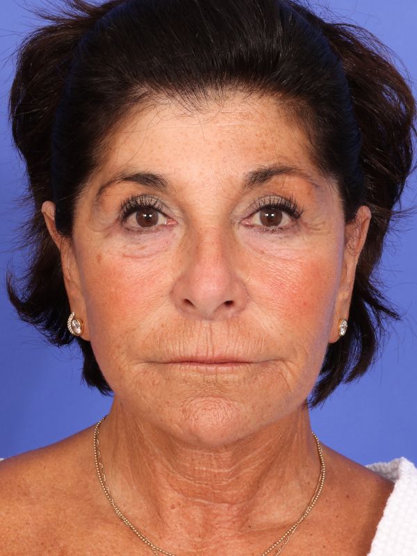 Face and Neck Lift Before & After Image