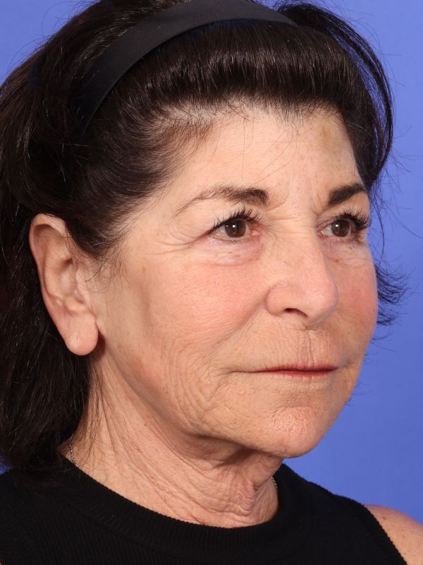 Face and Neck Lift Before & After Image