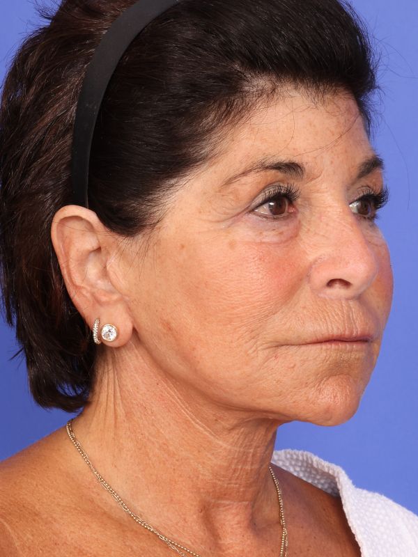 Face and Neck Lift Before & After Image