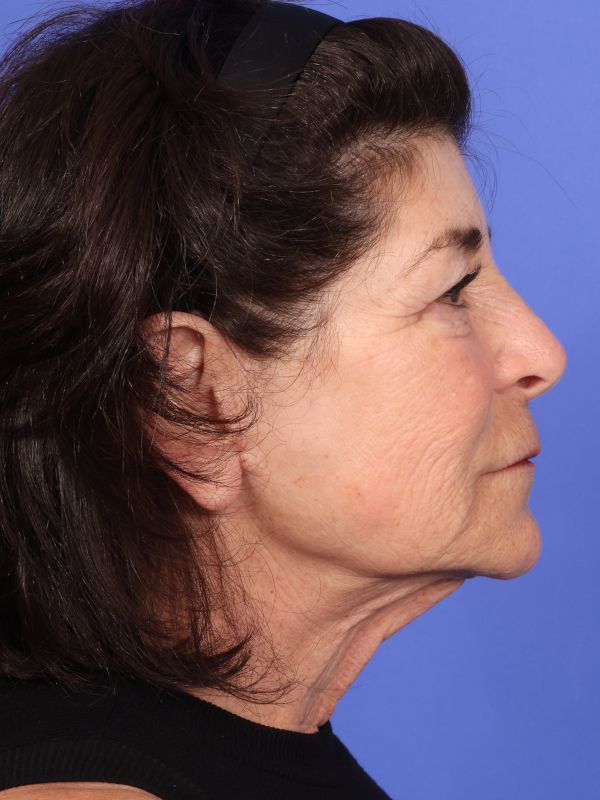 Face and Neck Lift Before & After Image