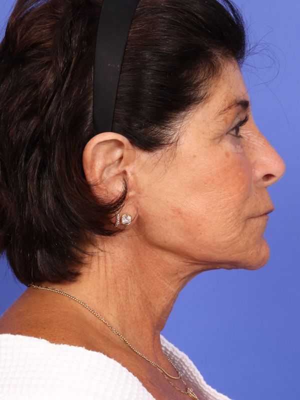 Face and Neck Lift Before & After Image