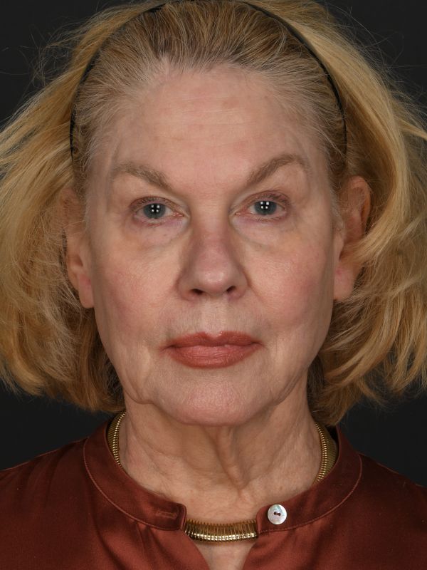 Face and Neck Lift Before & After Image
