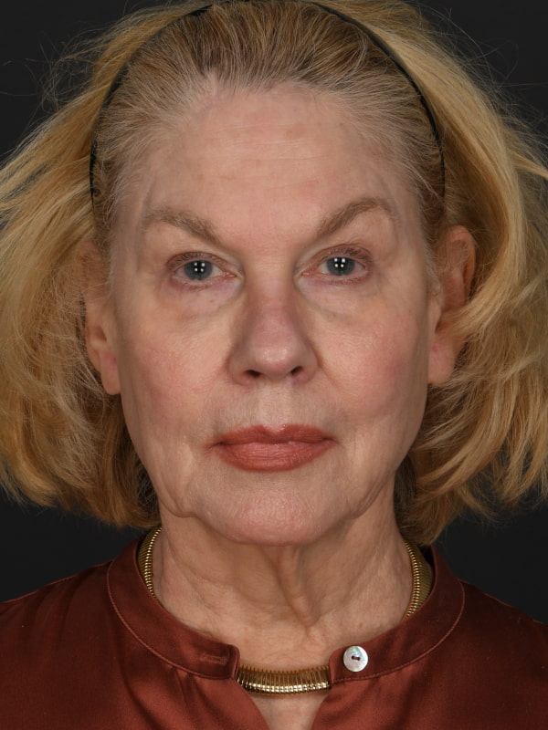 Facial Fat Grafting Before & After Image