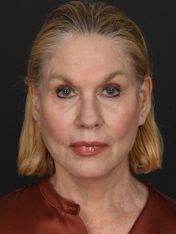 Facial Fat Grafting Before & After Image