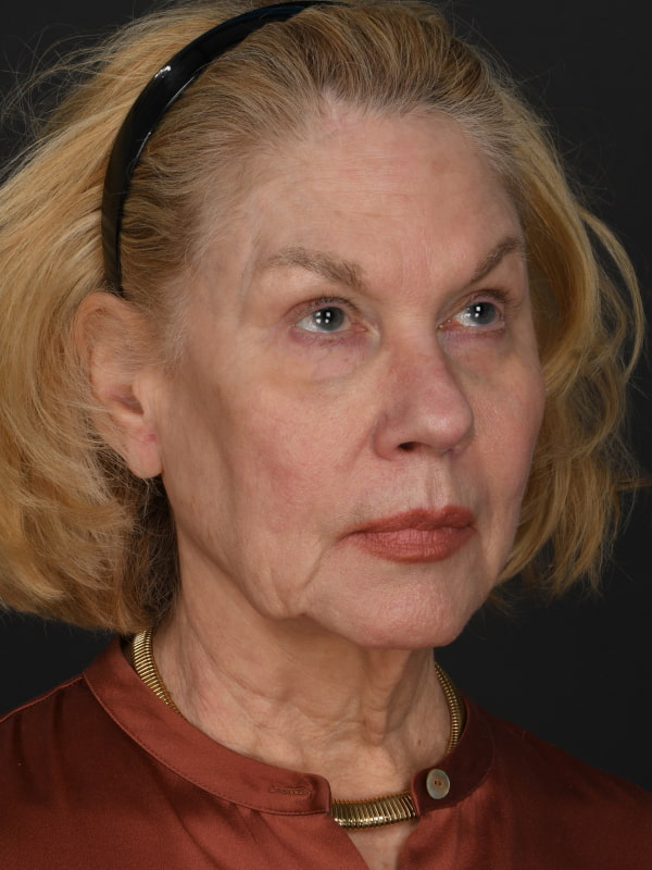 Facial Fat Grafting Before & After Image