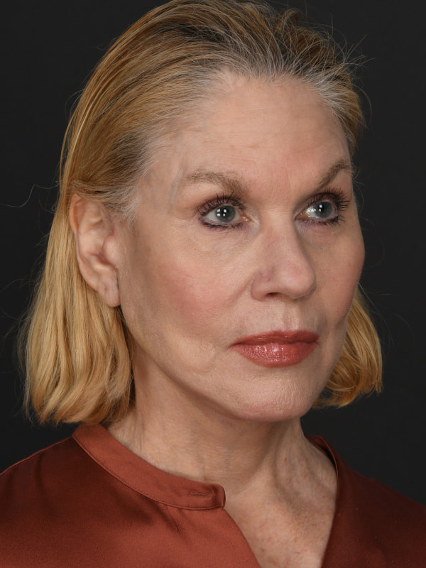 Facial Fat Grafting Before & After Image