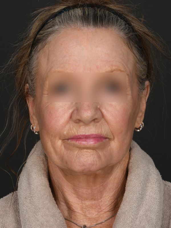 Laser Skin Resurfacing Before & After Image