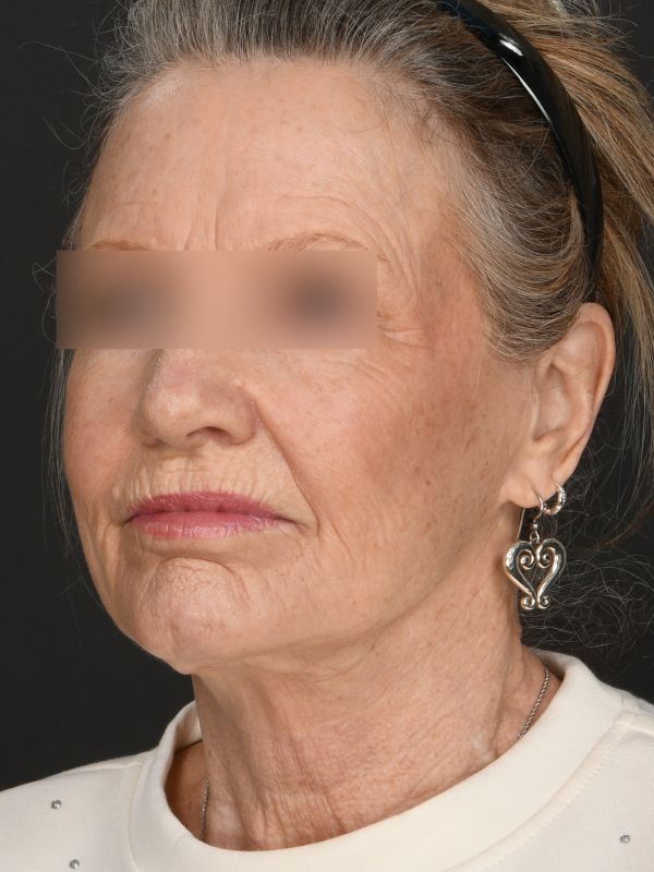 Laser Skin Resurfacing Before & After Image