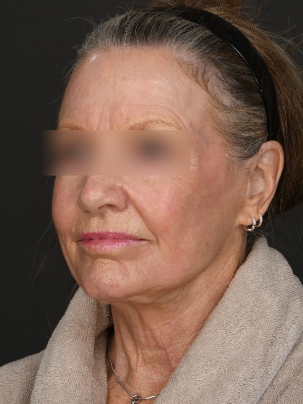 Laser Skin Resurfacing Before & After Image