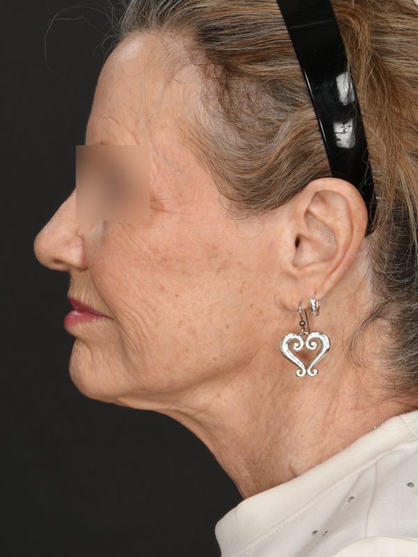 Laser Skin Resurfacing Before & After Image