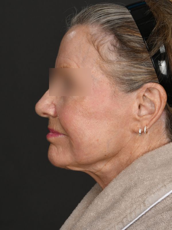 Laser Skin Resurfacing Before & After Image