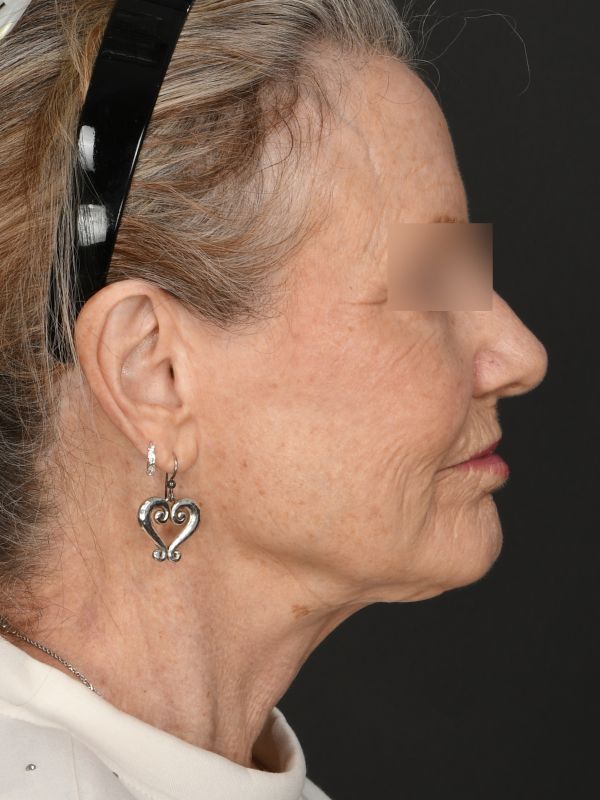 Laser Skin Resurfacing Before & After Image