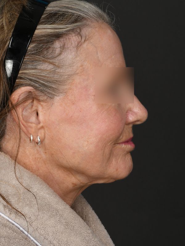 Laser Skin Resurfacing Before & After Image
