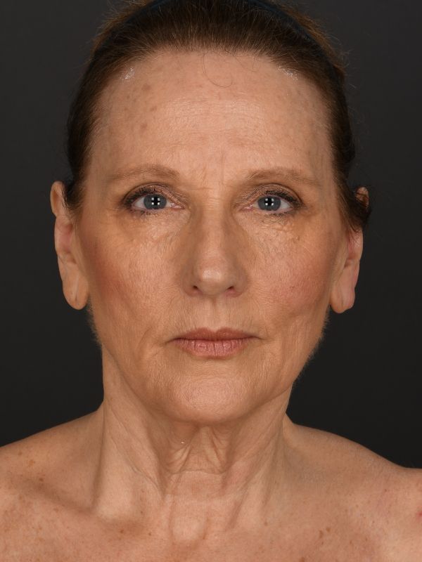 Laser Skin Resurfacing Before & After Image