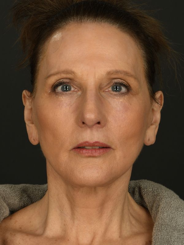 Laser Skin Resurfacing Before & After Image