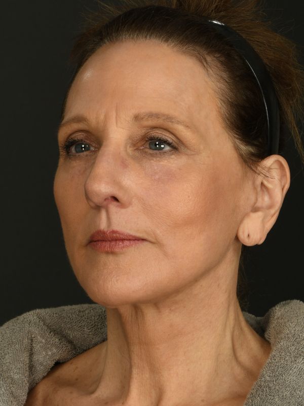 Laser Skin Resurfacing Before & After Image