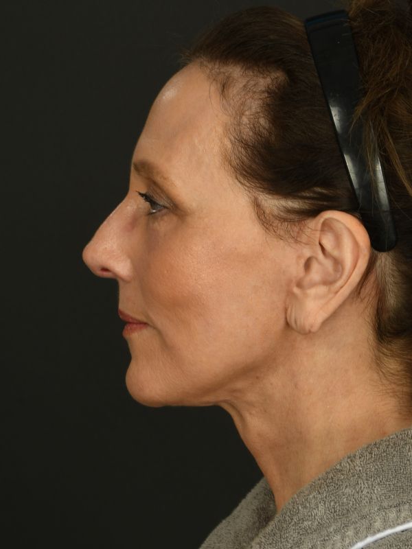 Laser Skin Resurfacing Before & After Image