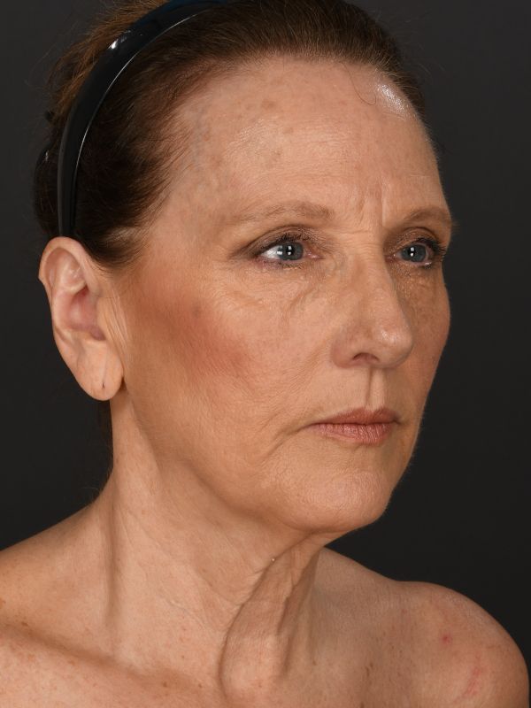 Laser Skin Resurfacing Before & After Image