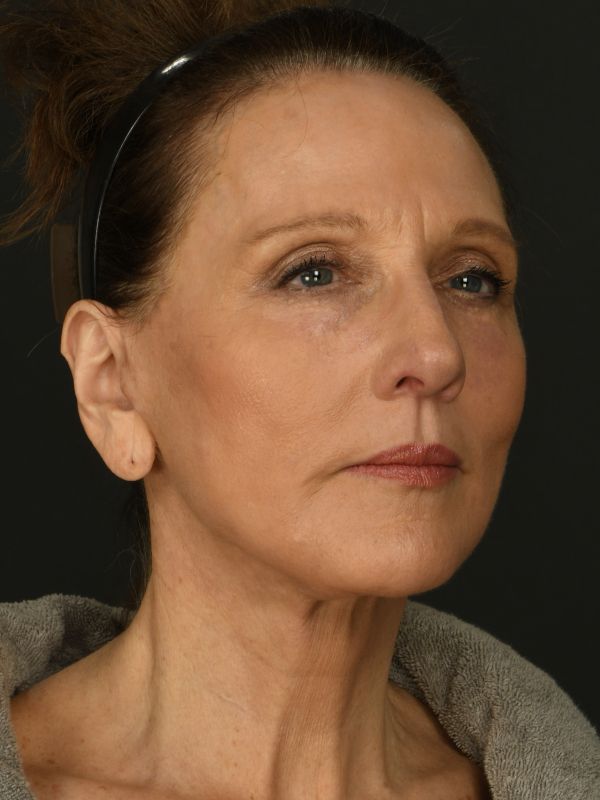 Laser Skin Resurfacing Before & After Image