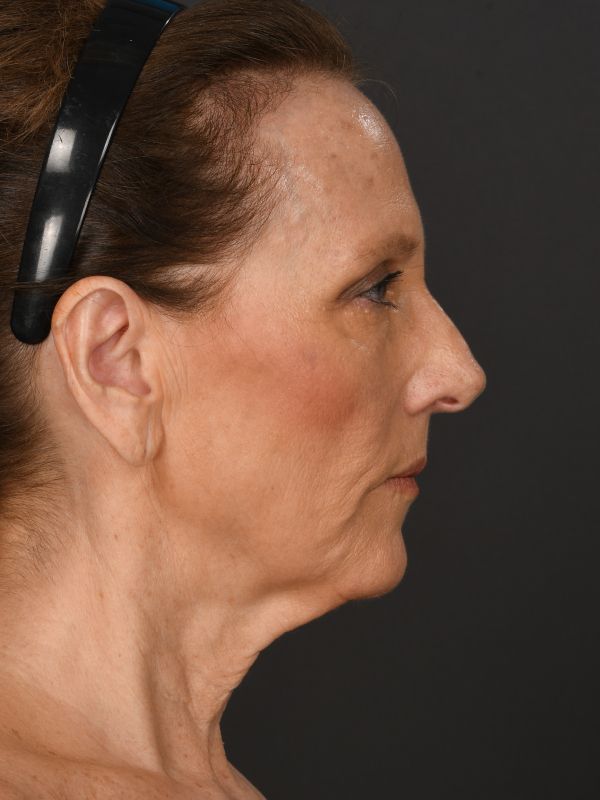 Laser Skin Resurfacing Before & After Image