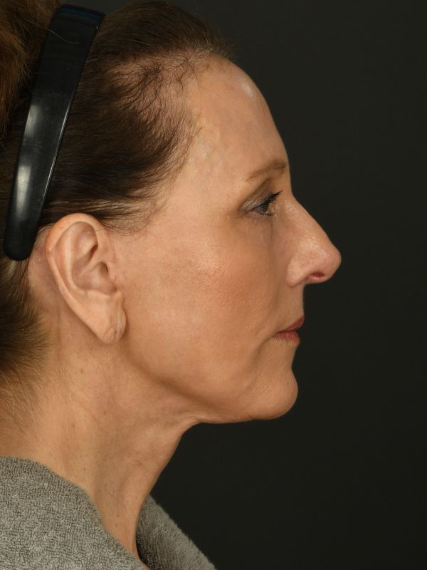 Laser Skin Resurfacing Before & After Image