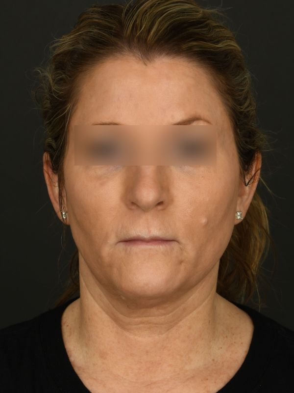 Laser Skin Resurfacing Before & After Image