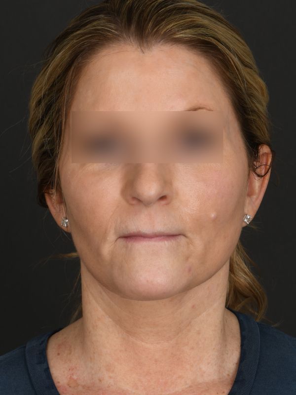 Laser Skin Resurfacing Before & After Image