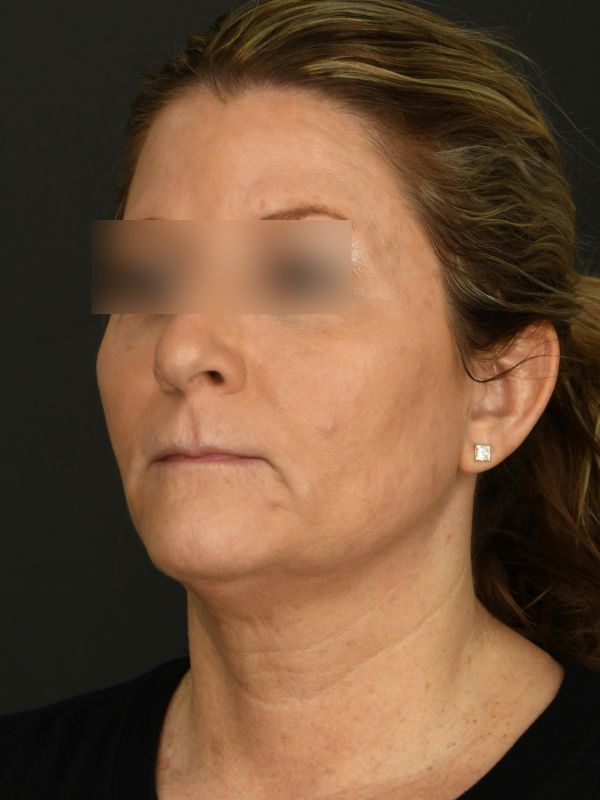 Laser Skin Resurfacing Before & After Image