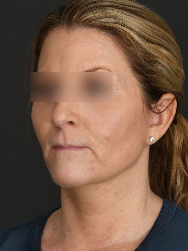 Laser Skin Resurfacing Before & After Image