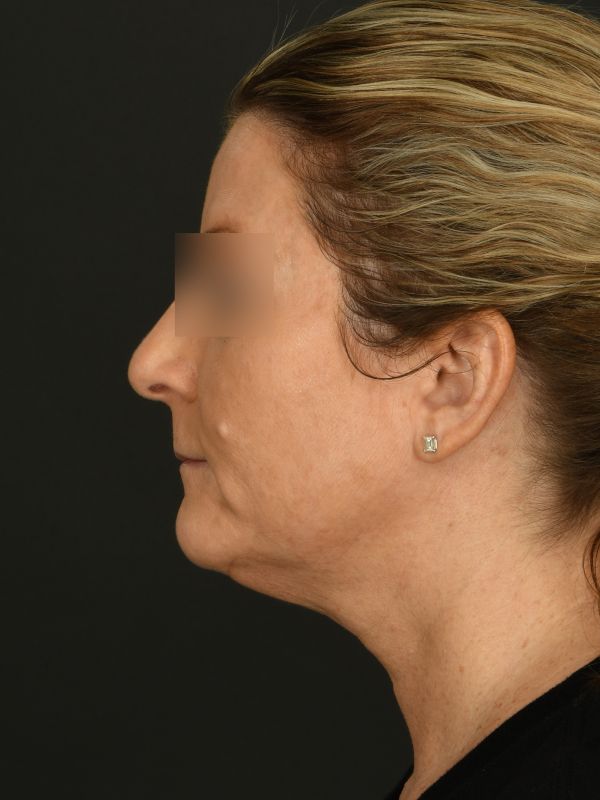 Laser Skin Resurfacing Before & After Image
