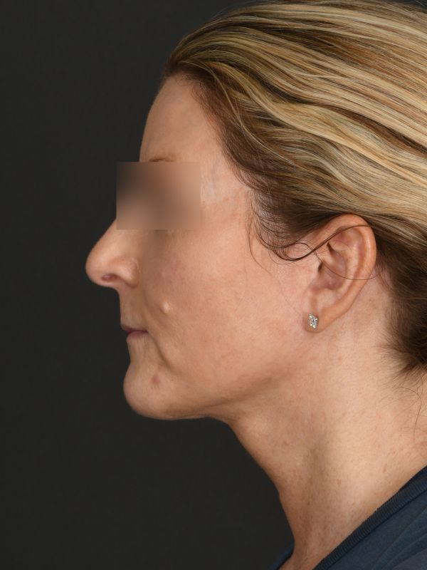 Laser Skin Resurfacing Before & After Image
