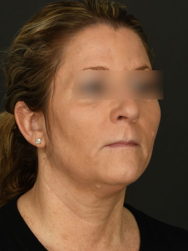 Laser Skin Resurfacing Before & After Image