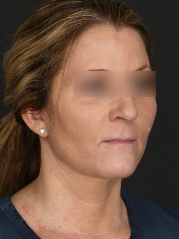 Laser Skin Resurfacing Before & After Image