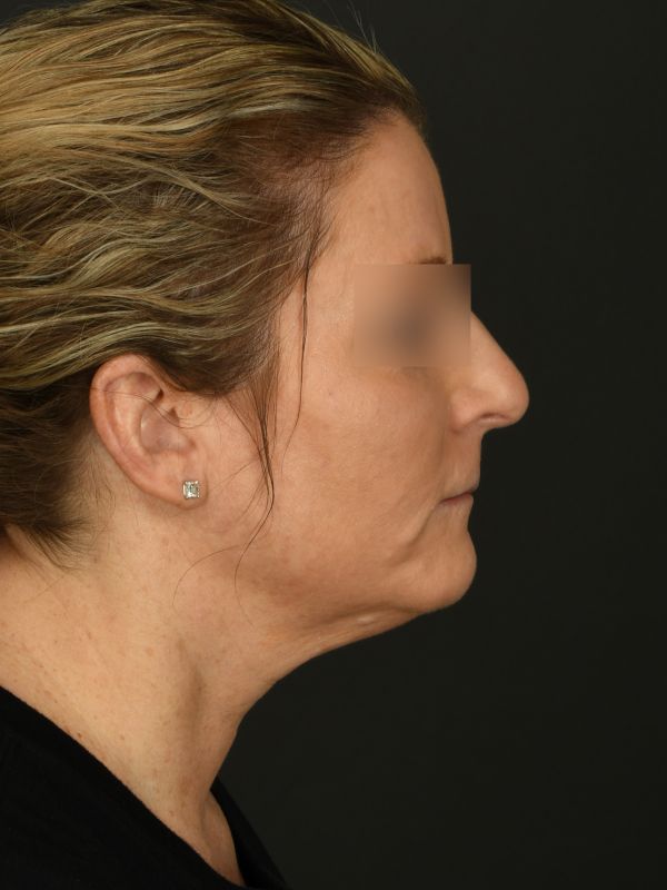 Laser Skin Resurfacing Before & After Image