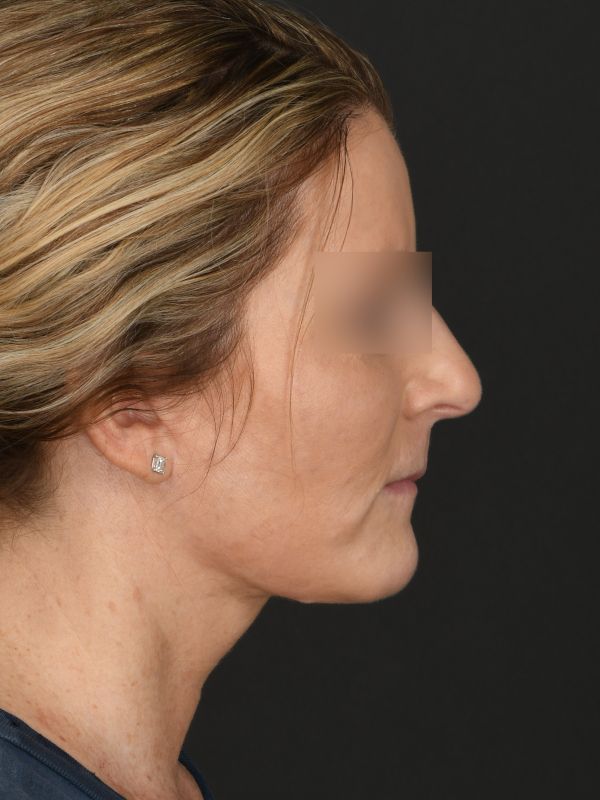 Laser Skin Resurfacing Before & After Image